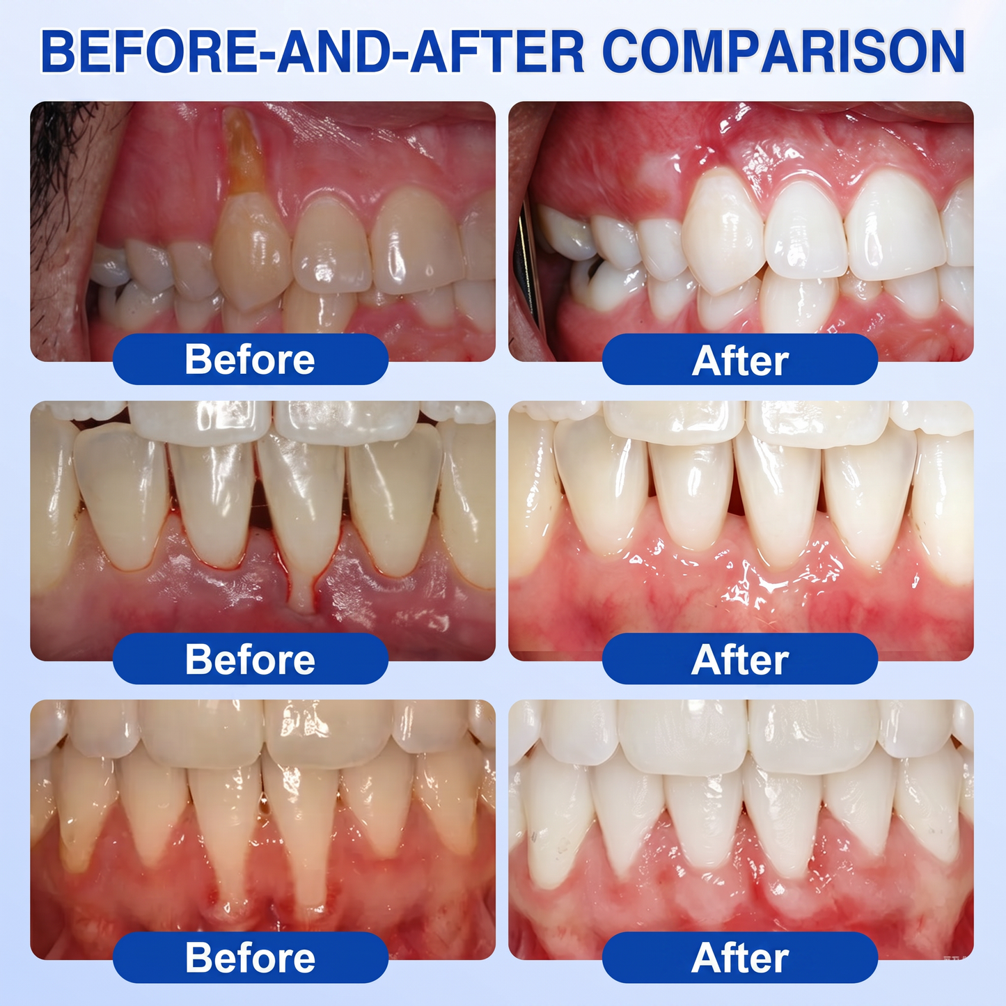 🇬🇧 Glimmerly® 🦷GumRevive periodontal repair gel💎